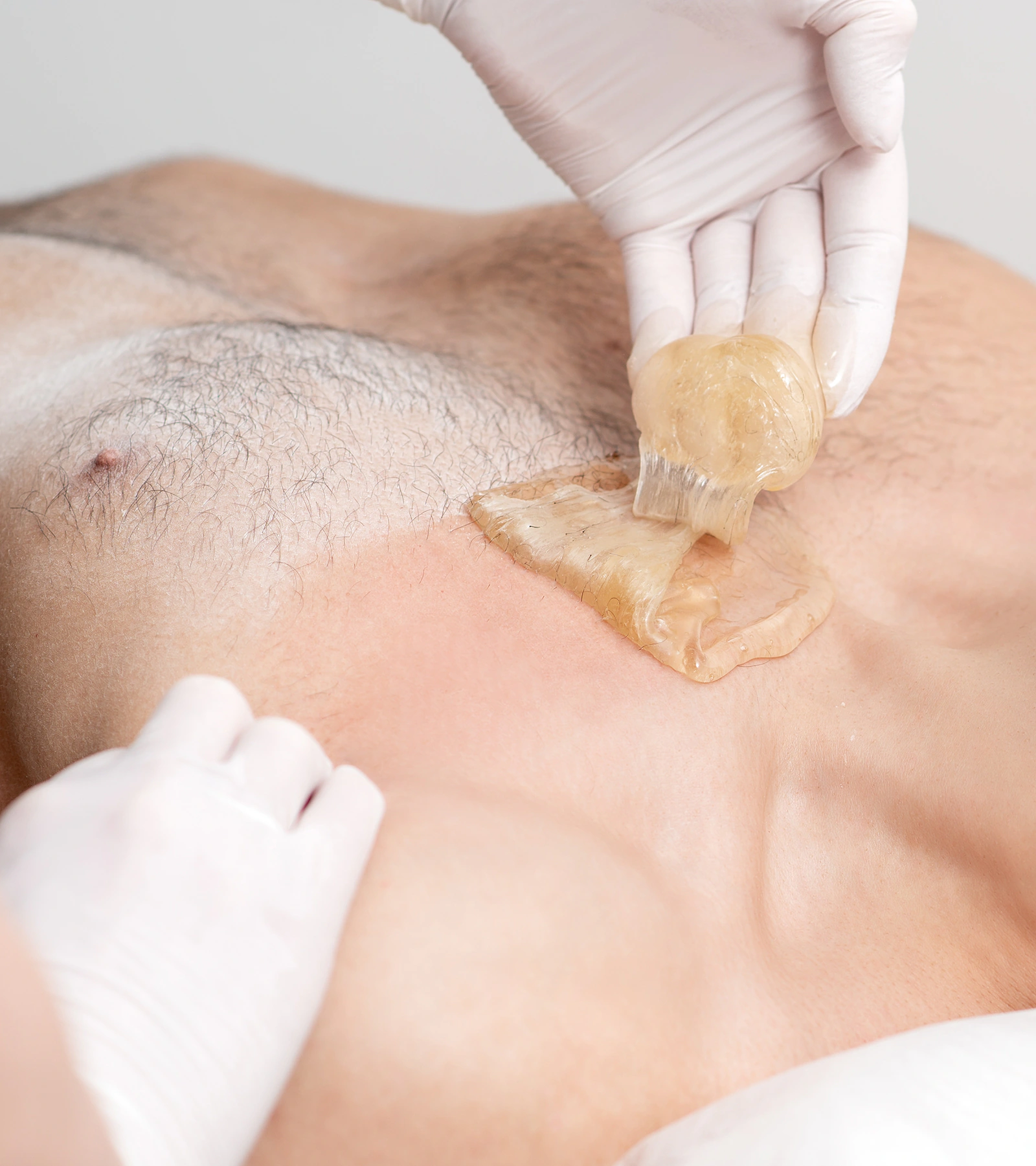 Épilation conventionnelle