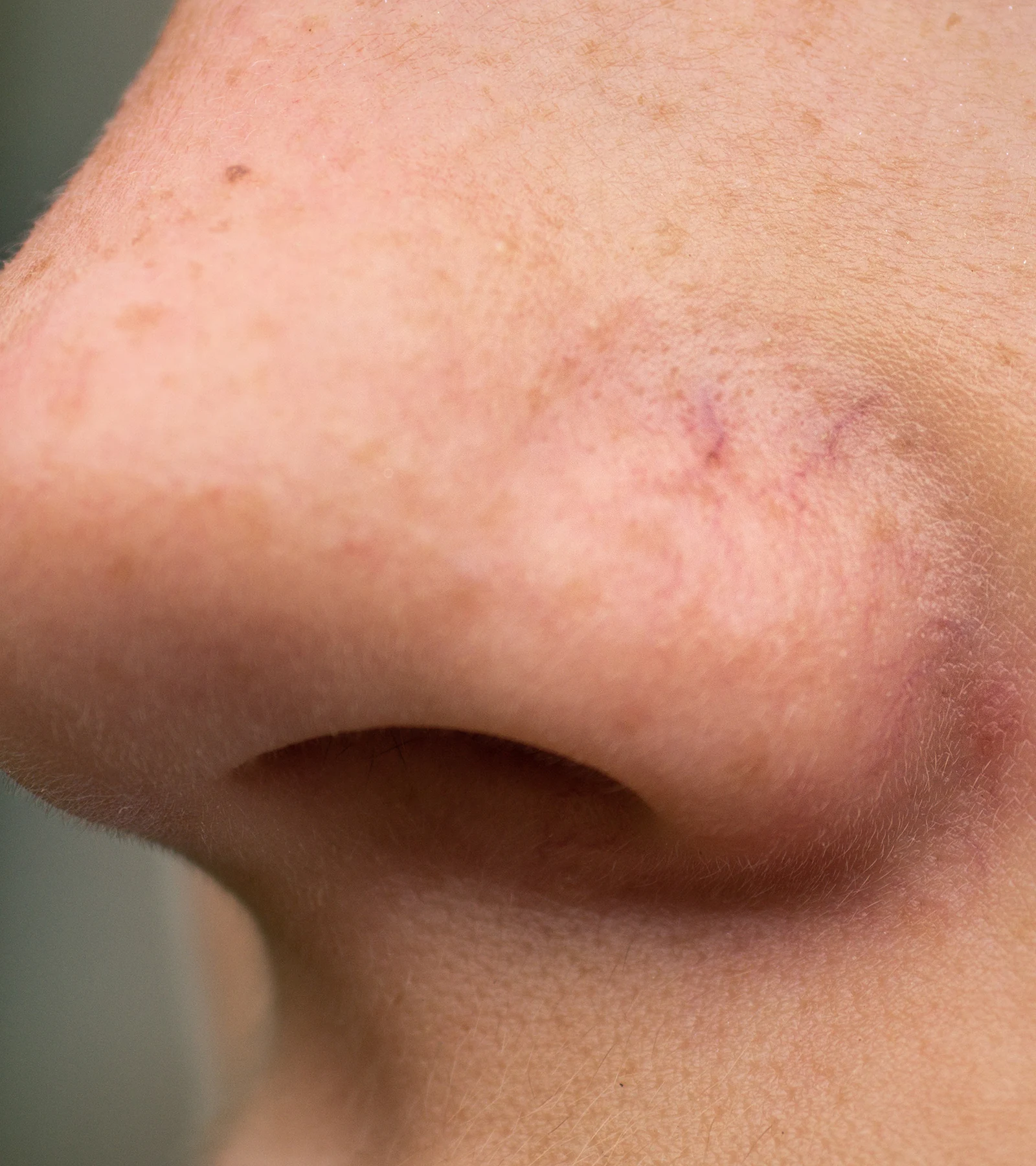 Traitement des lésions vasculaires