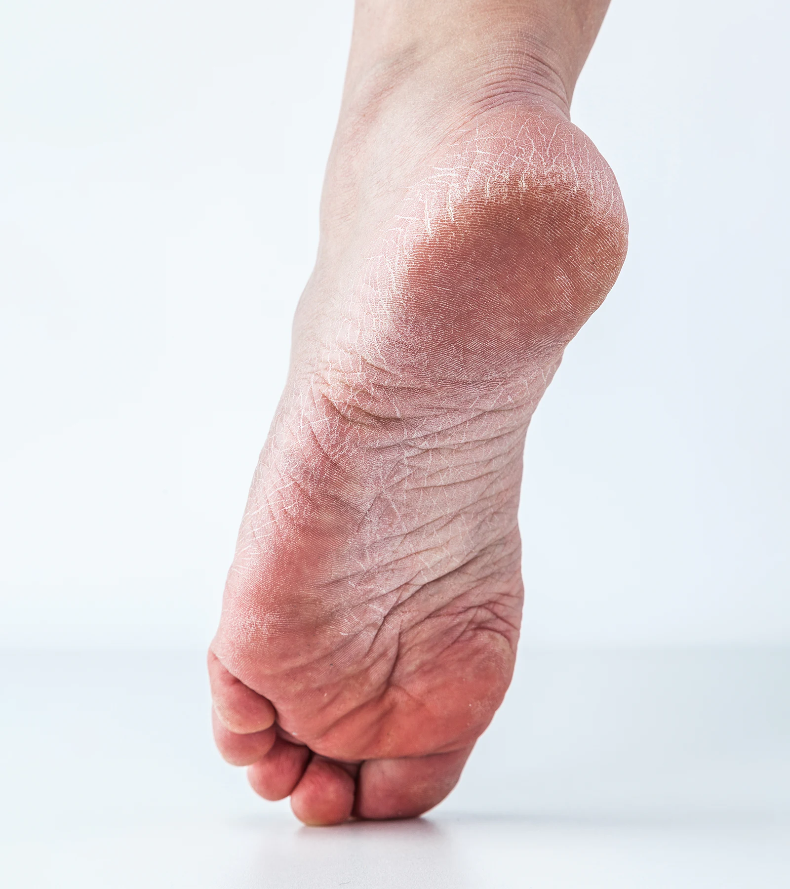 dehydrated-skin-female-heels
